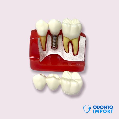 Macro modelo Implantes