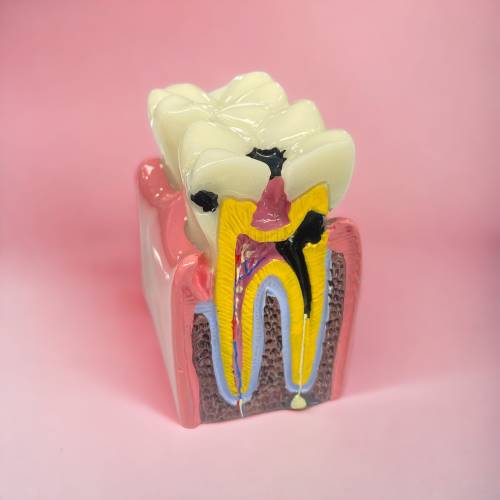 Macro modelo de Caries