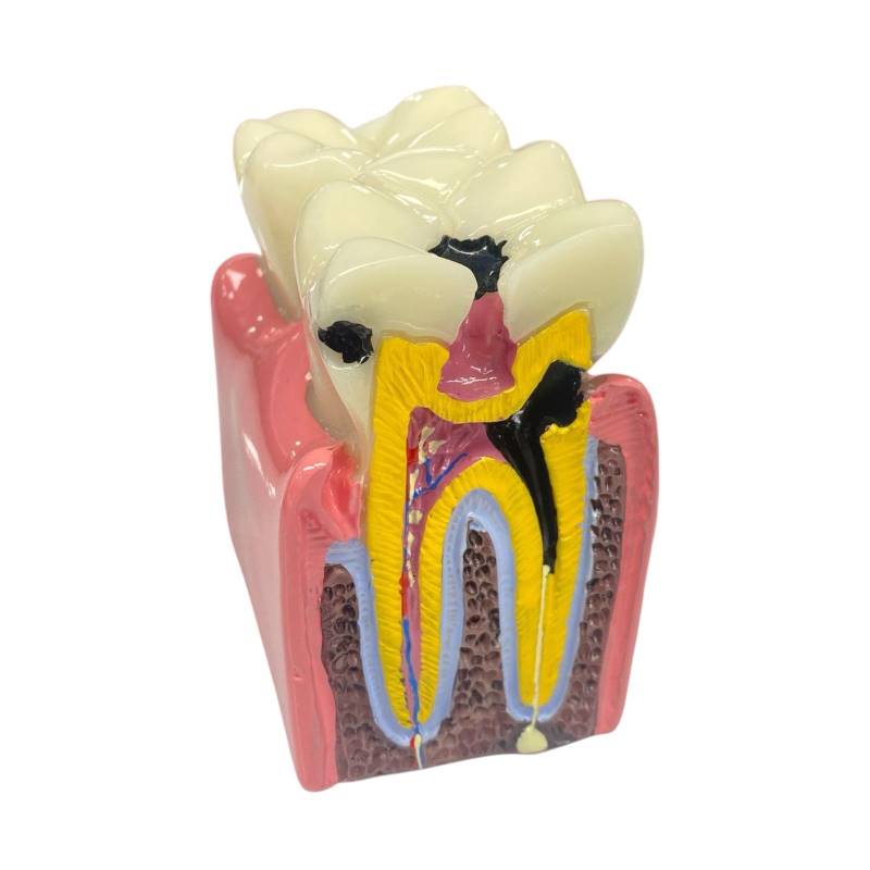 Macro Modelo Caries