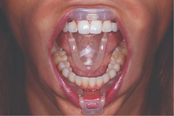 Retractor de labios Umbrella ultradent 
